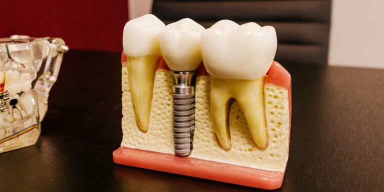 Dental Implants